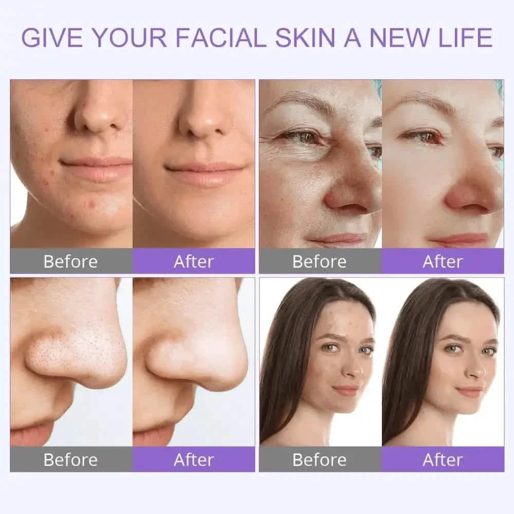 6 In 1 Hydra Dermabrasion Machine Pro Bundle - CE & RoHS Certified