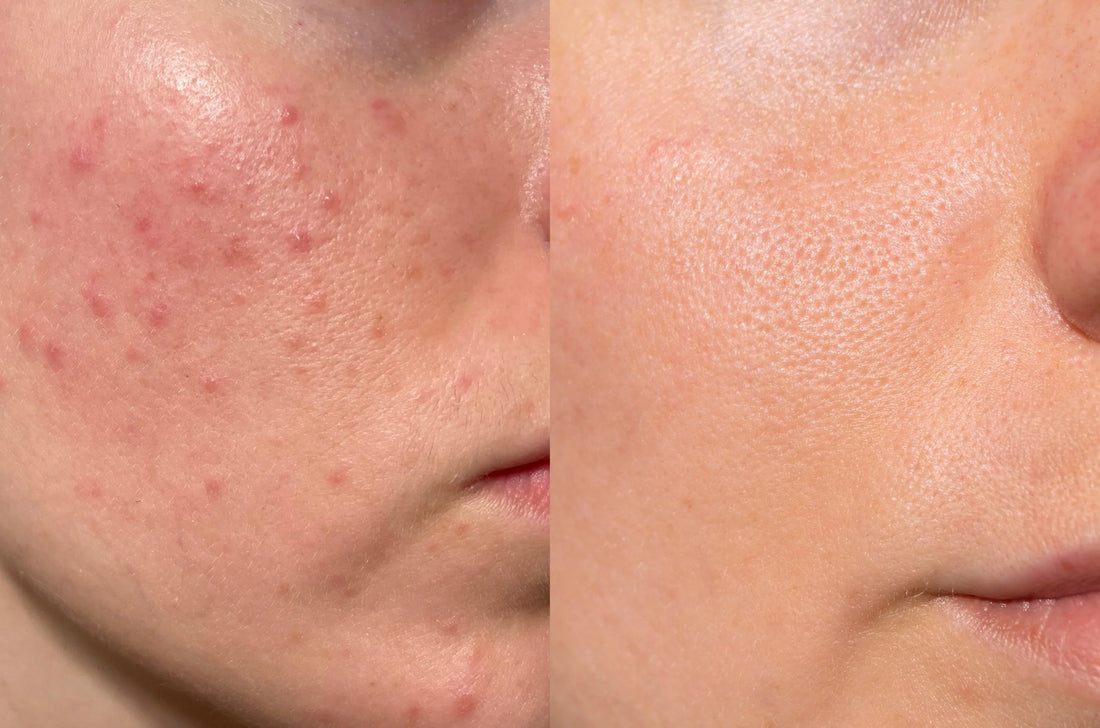 Hydrodermabrasion for Acne-Prone Skin