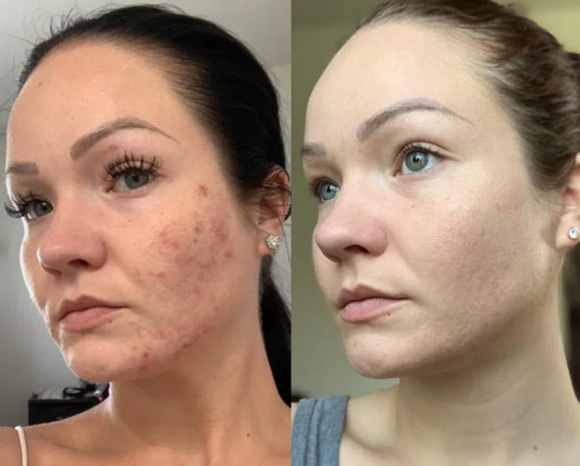 comment atténuer l’apparence des boutons sur le visage en une nuit