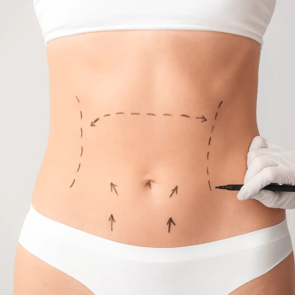 Non Surgical Abdominoplasty