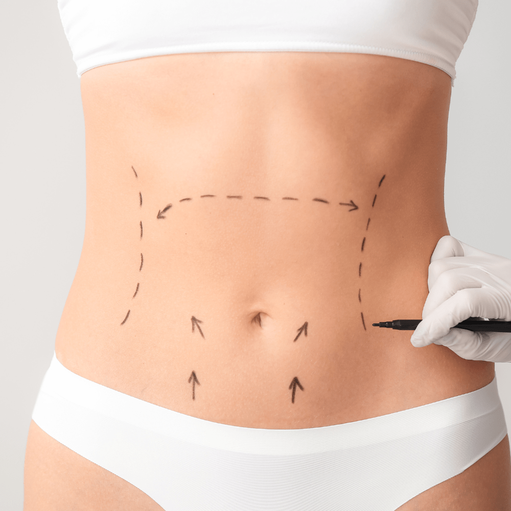 Non Surgical Abdominoplasty