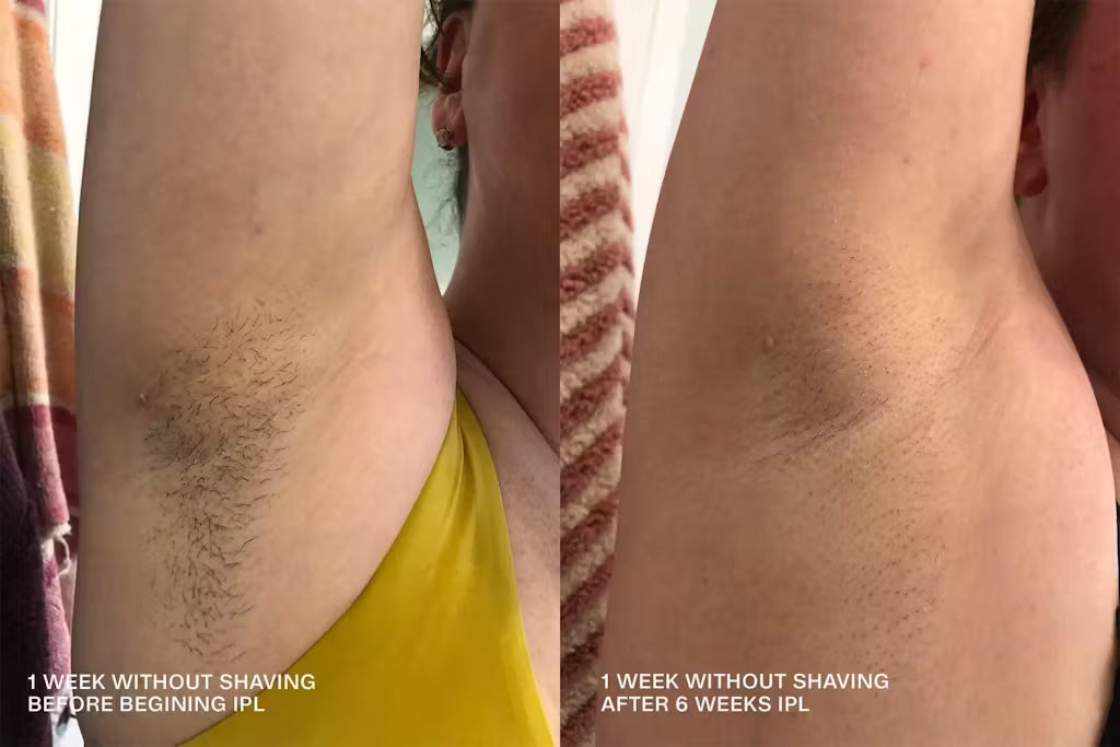 Laser IPL Hair Removal