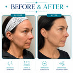 face lift machine