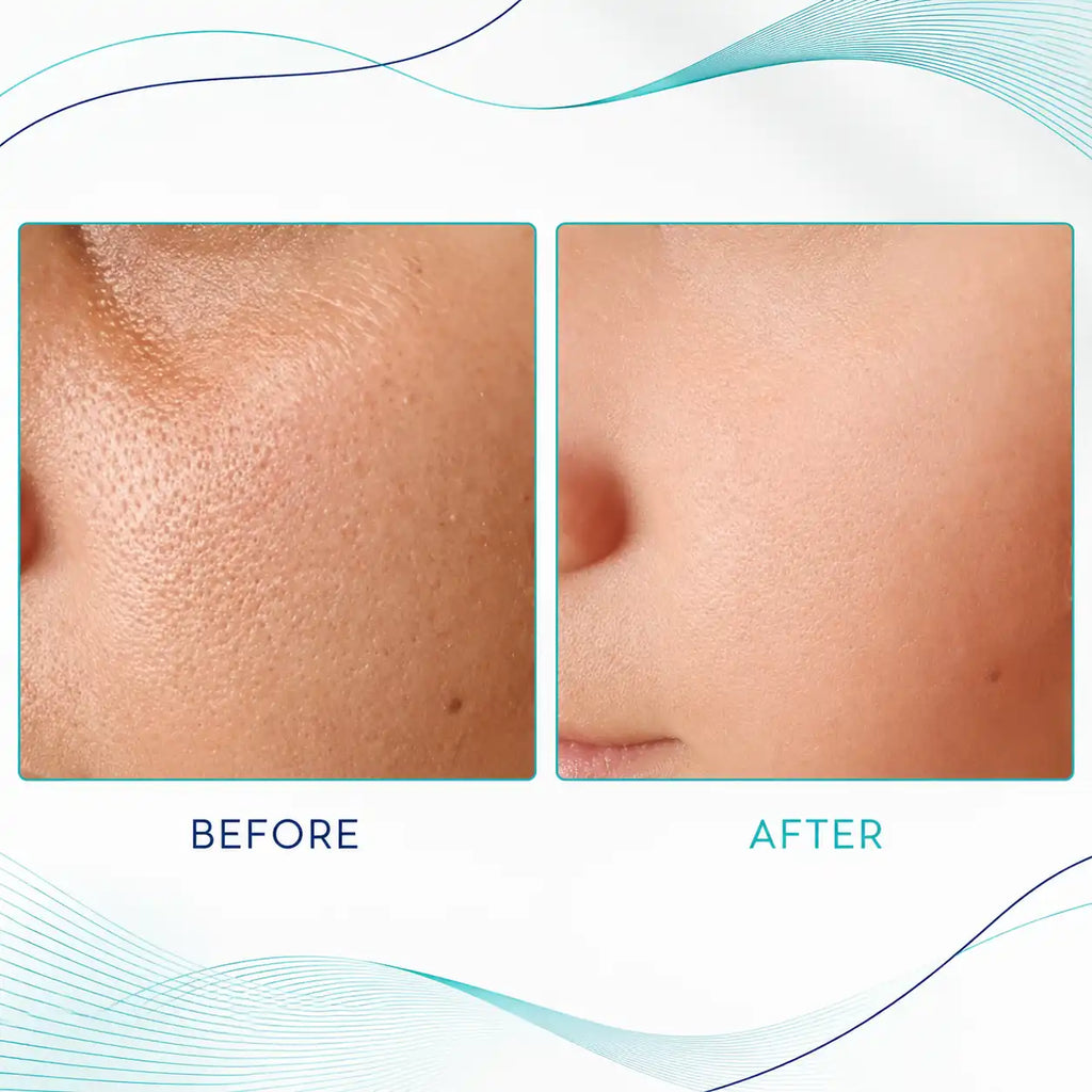 microneedling with radiofrequency machines