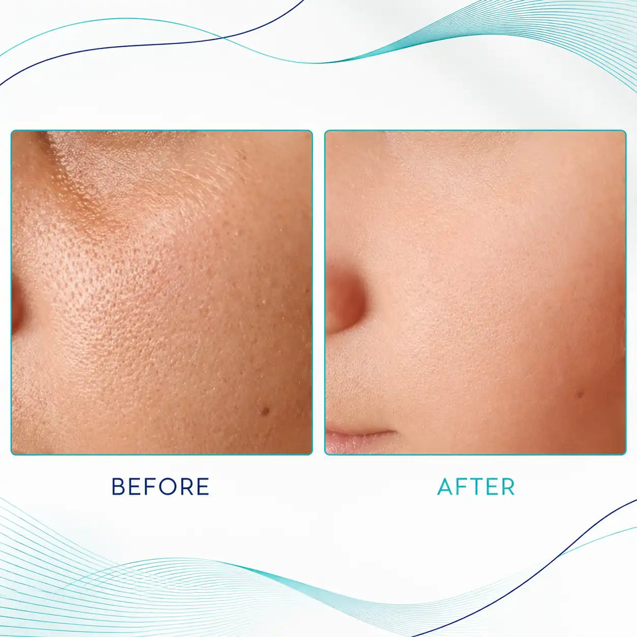 microneedling with radiofrequency machines