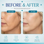 hydrodermabrasion machine