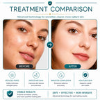 rf microneedling devices