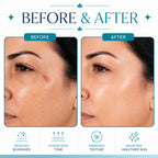 rf facial machine