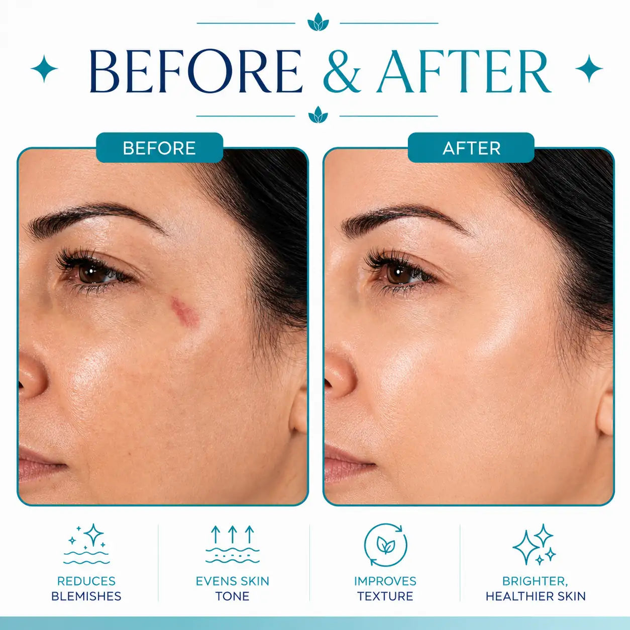 rf facial machine