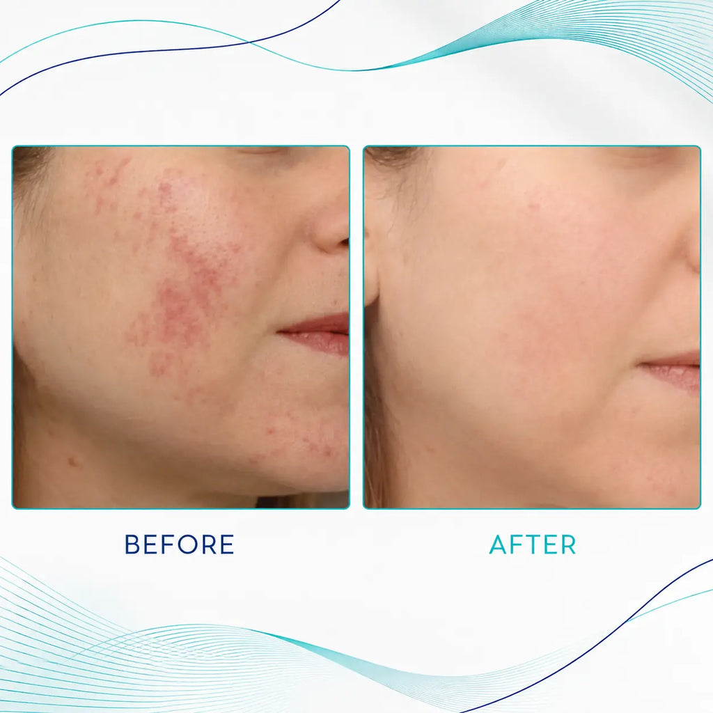 best rf microneedling machines