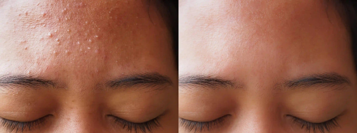 6 in 1 hydrafacial machine