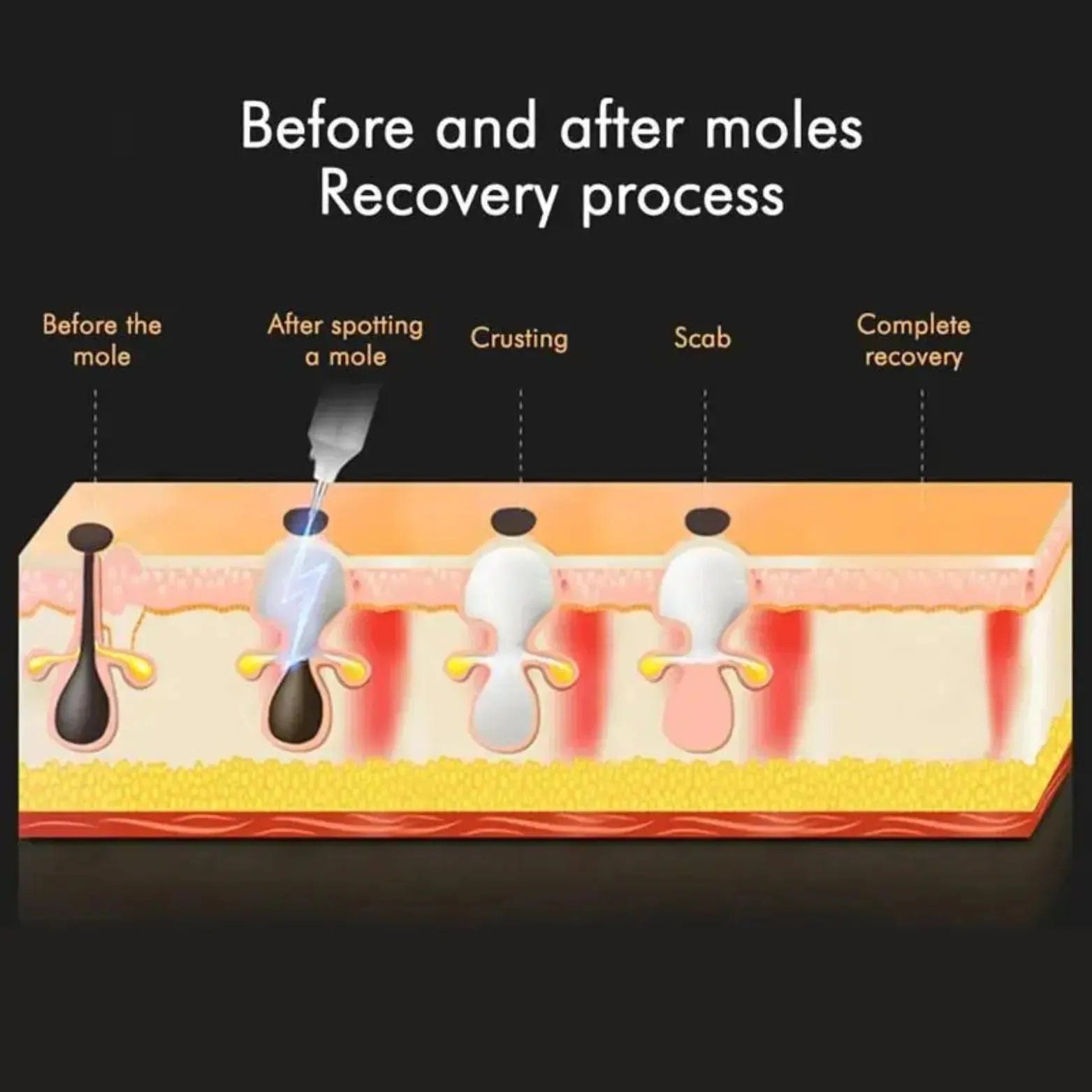 plasma pen treatment