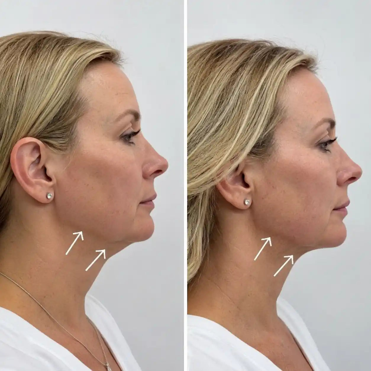 HIFU BEFORE AND AFTER