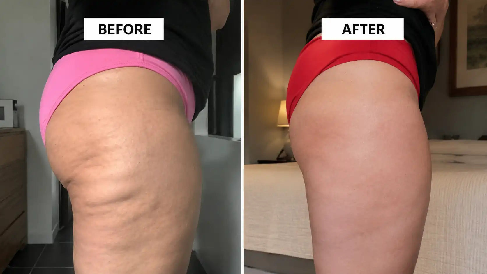 HIFU BEFORE AND AFTER