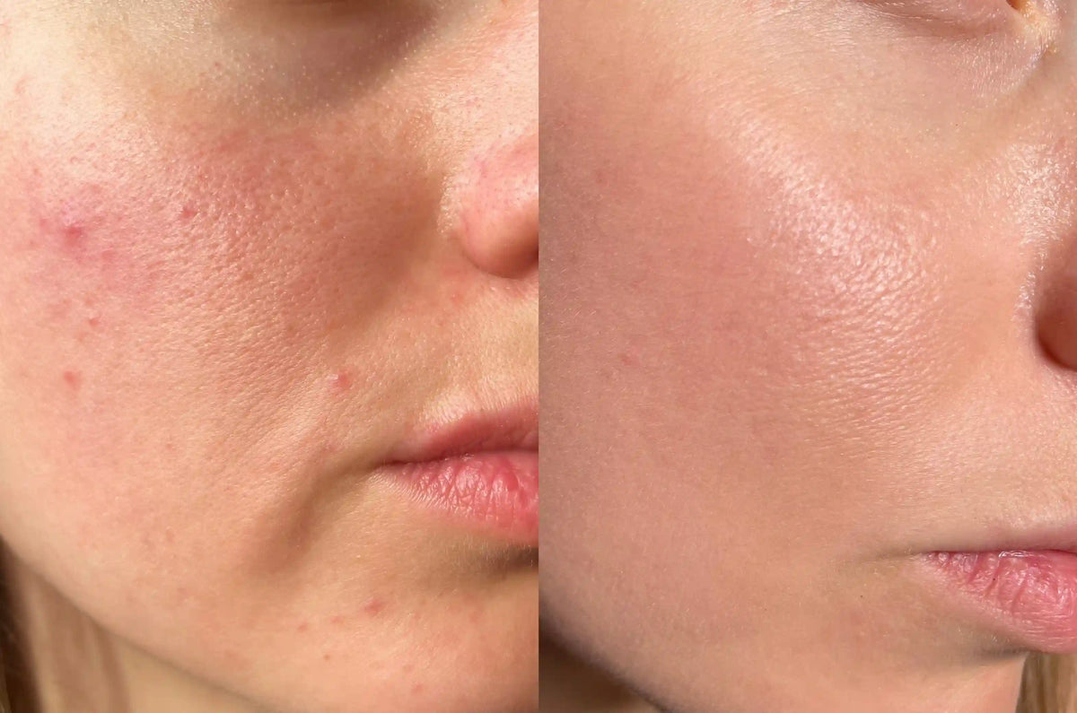 Hydradermabrasion machine