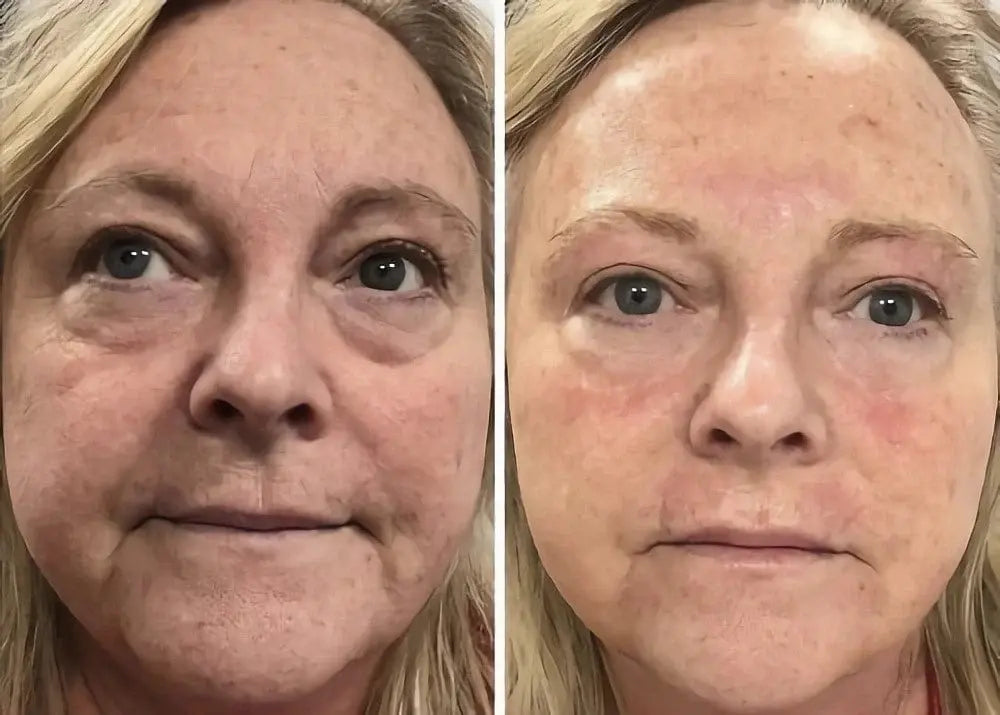 Hydrafacial Before and After Wrinkles