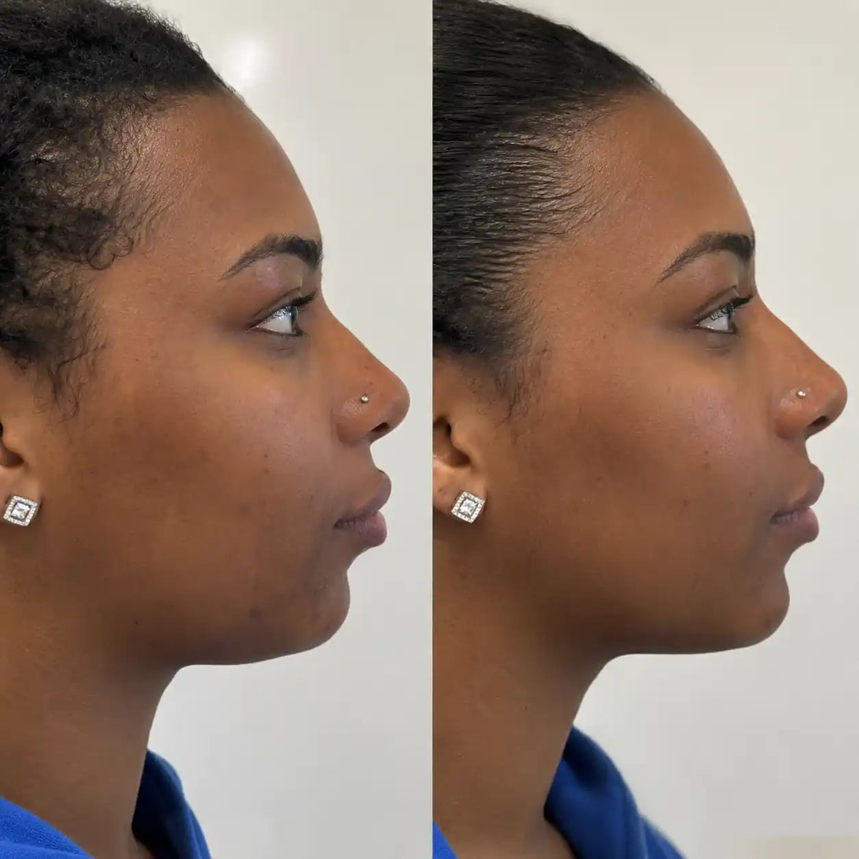 hifu before and after jawline