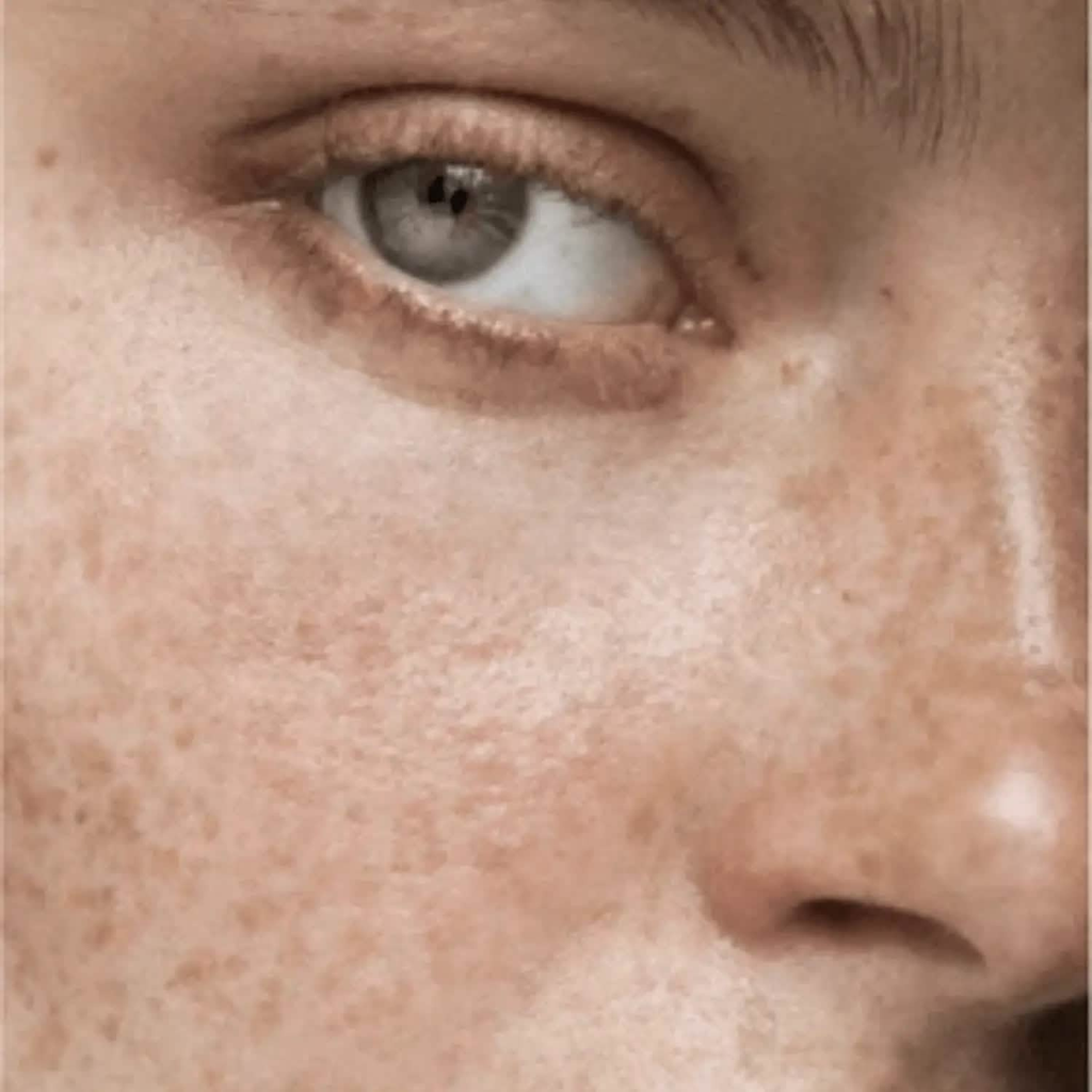 hyperpigmentation serum for face