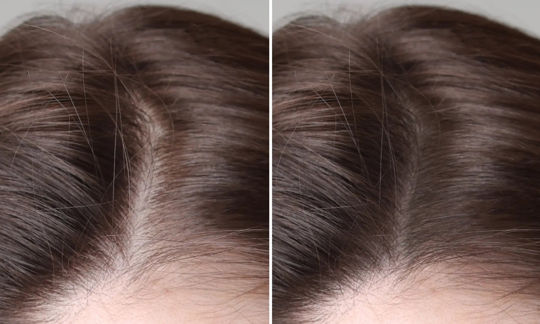 acne treatment dermatologist