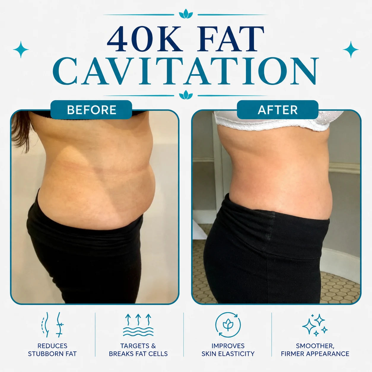 anti cellulite machine UK
