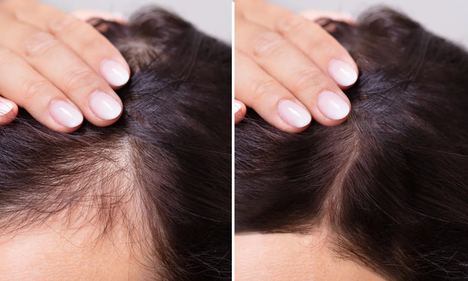 best acne treatment uk​