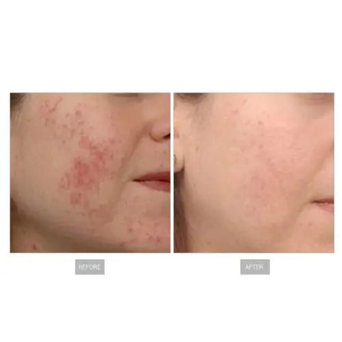 best rf microneedling machines