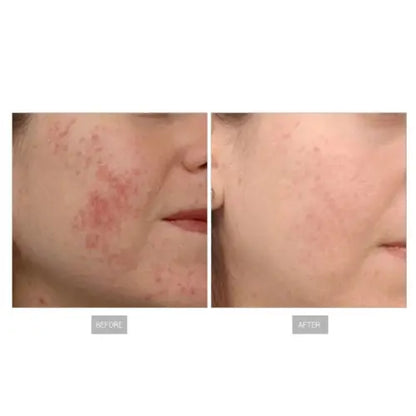 best rf microneedling machines