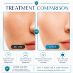rf microneedling device