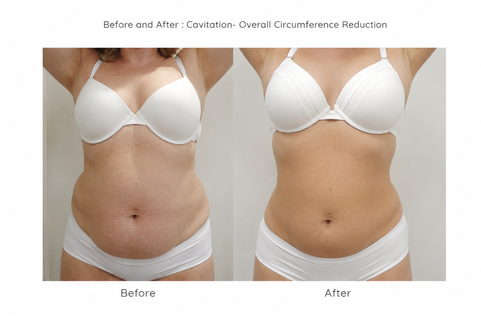 cavitation machine