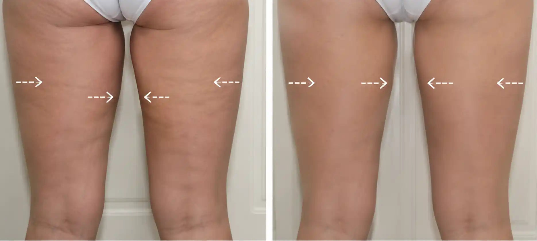 cavitation machine