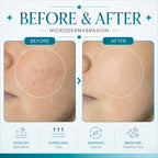 microdermabrasion machine​