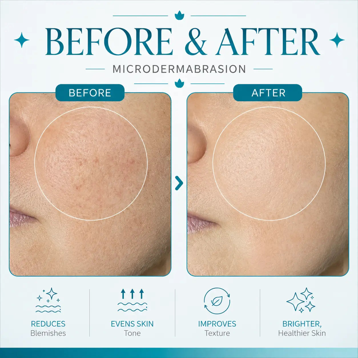 microdermabrasion machine​