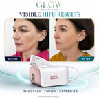 hifu devices
