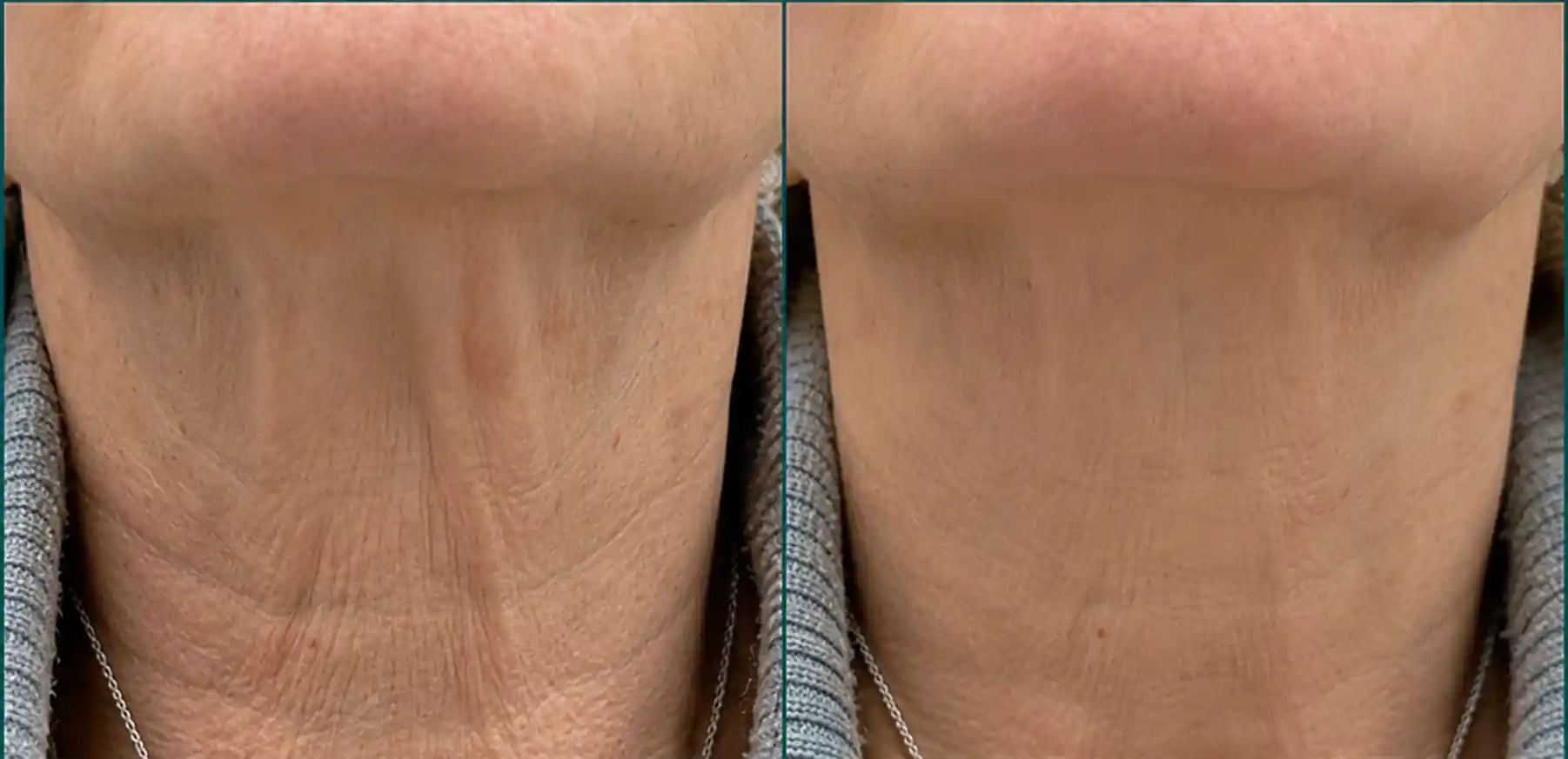hifu before and after