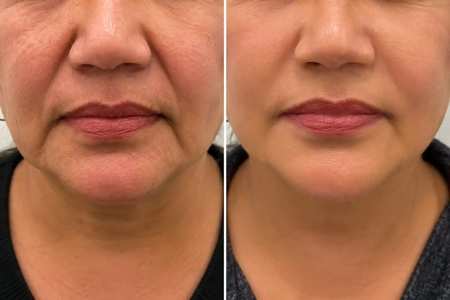 hifu before and after jowls