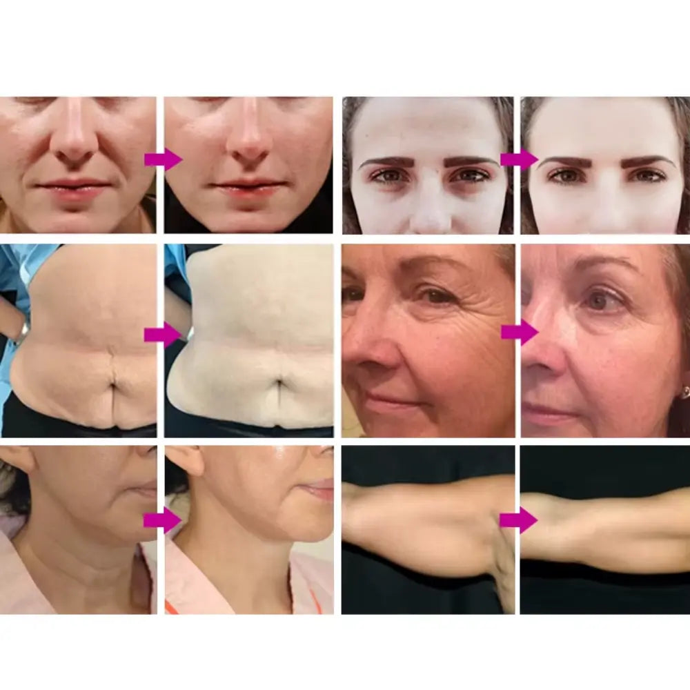 hifu portable machine