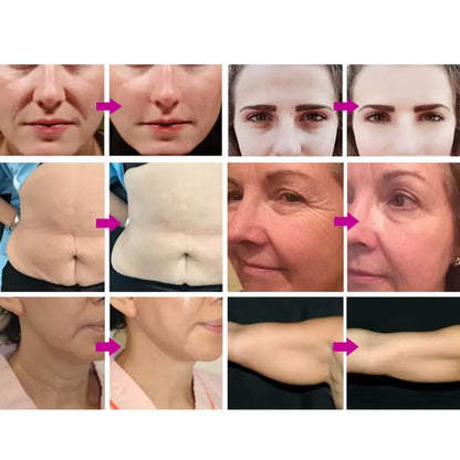 hifu portable machine