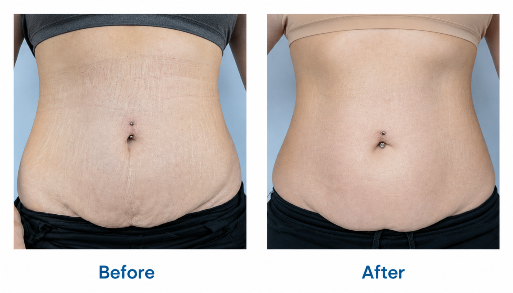 hifu treatment before and after