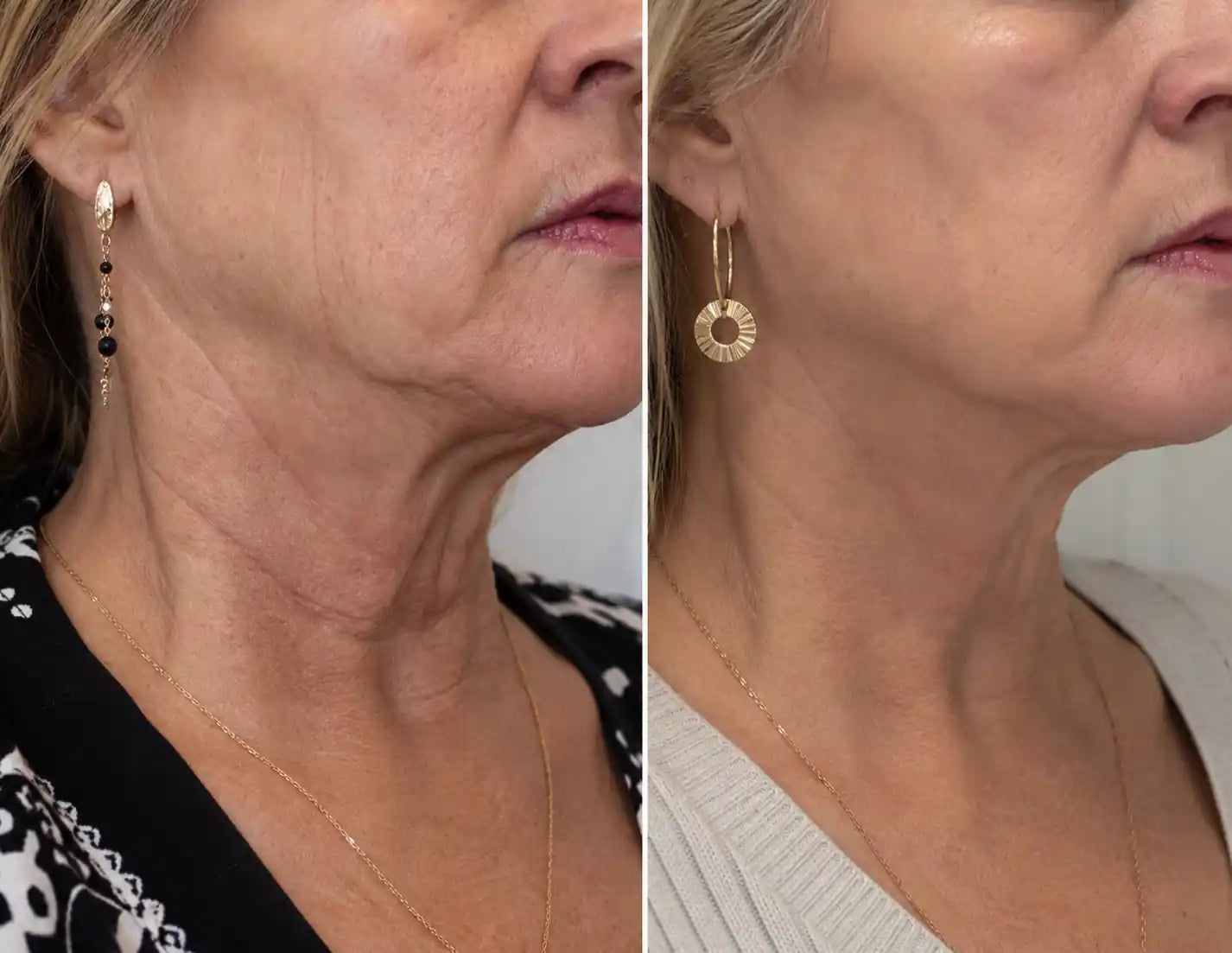 hifu treatment before and after