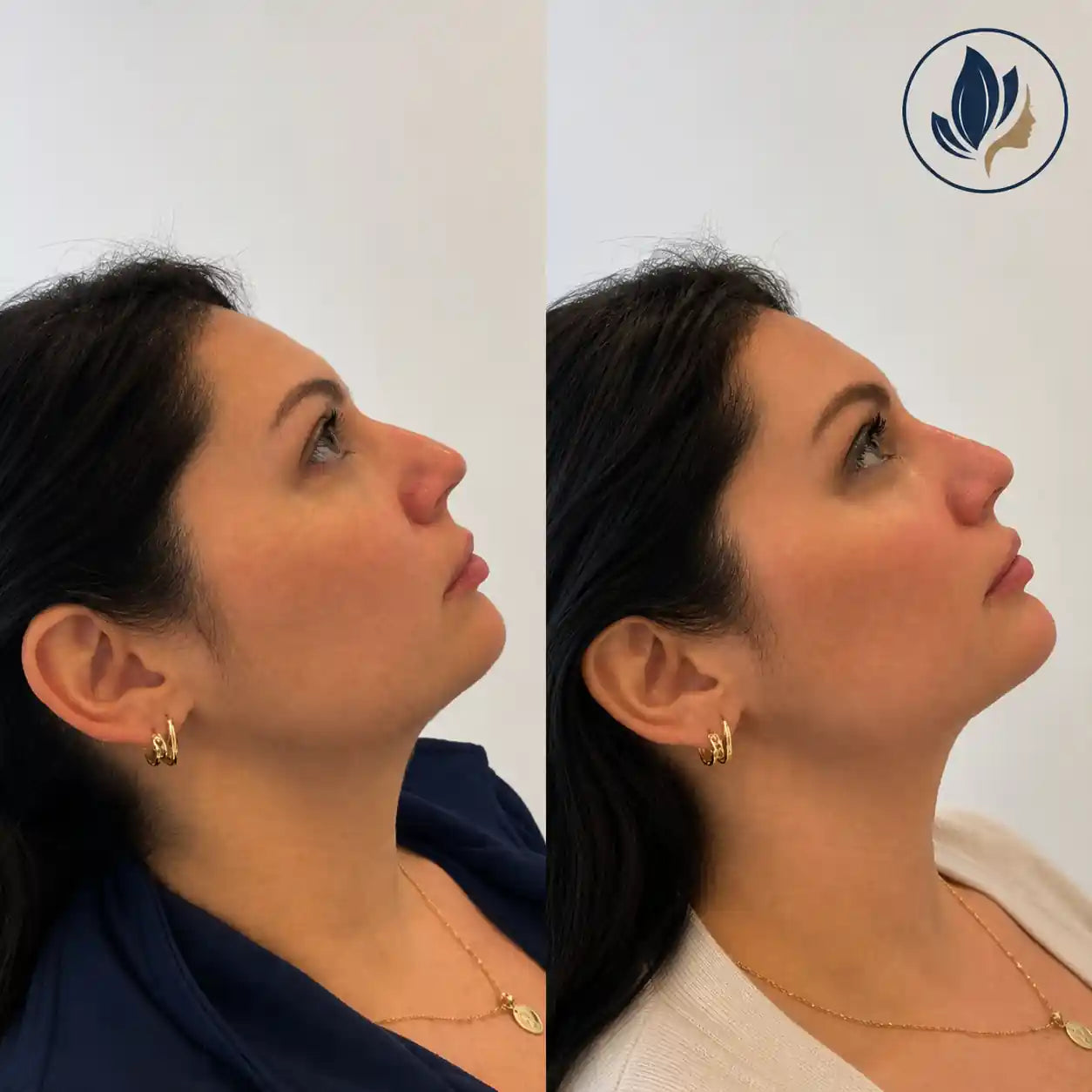 hifu treatment before and after