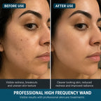 high frequency facial machine