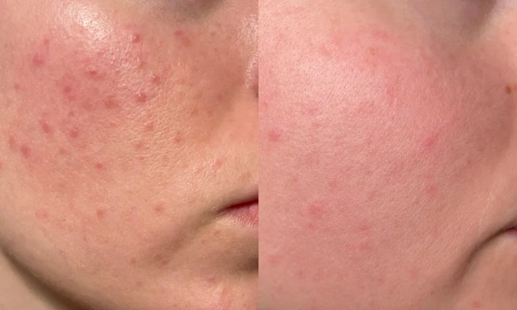 high frequency wand for acne