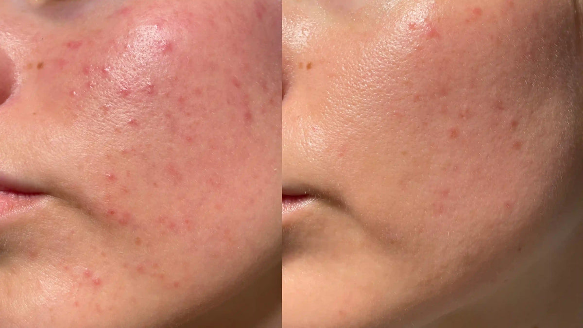 hydro facial machine