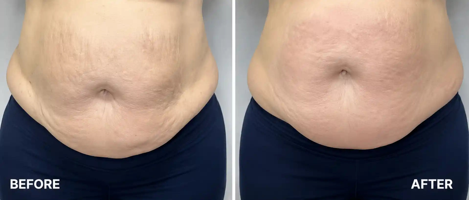 lymph drainage therapy machine
