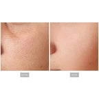 microneedling with radiofrequency machines
