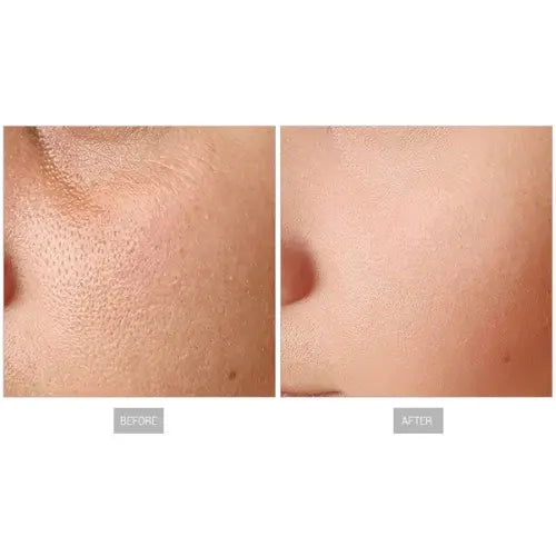 microneedling with radiofrequency machines