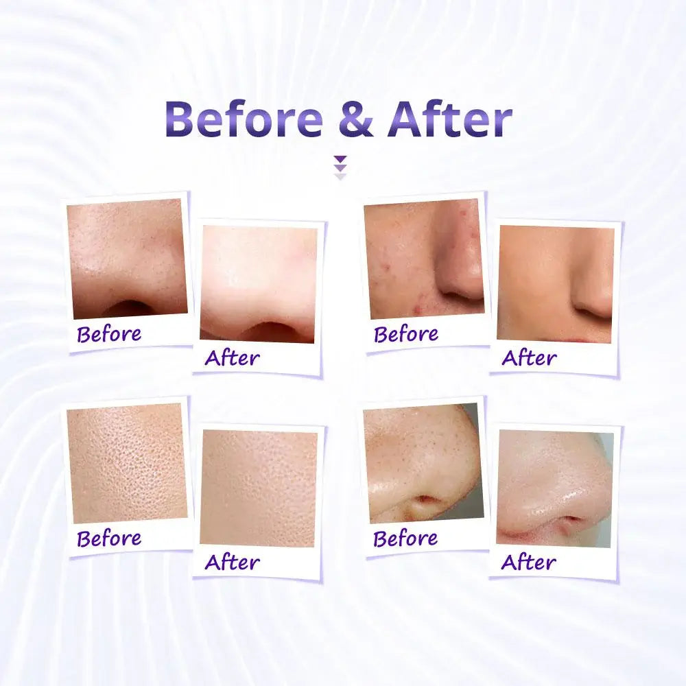 new spa diamond microdermabrasion machine