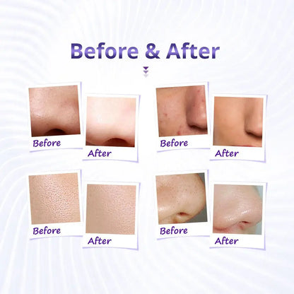 new spa diamond microdermabrasion machine