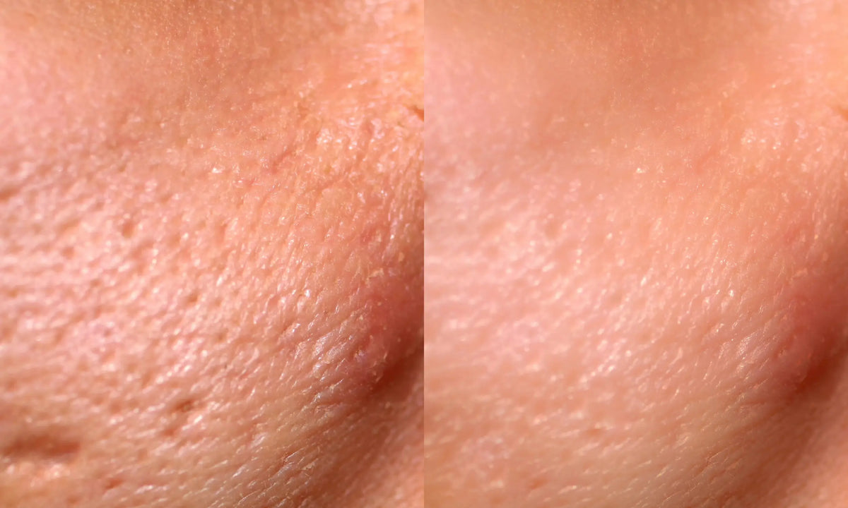 radio frequency skin tightening at home