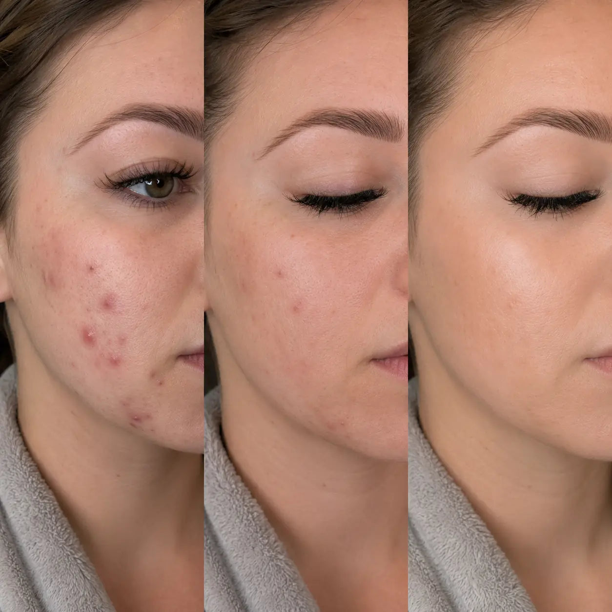 rf microneedling devices